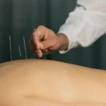 Significance of Acupuncture in Modern world 