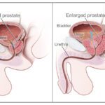 best treatment for benign prostatic hyperplasia in Trivandrum