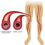 DIABETIC ARTERY DISEASE